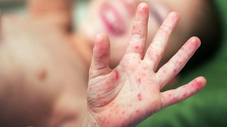 μπακογεώργου-χαρά-παιδίατρος-πετρούπολη-post-7-1200x701