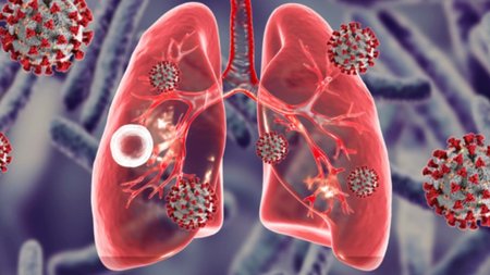 coronavirus-tuberculosis_SH_1064066363-860x573-1-860x570-1