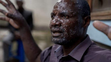 2024-07-24T083716Z_743285404_RC2EW8ANCTVB_RTRMADP_5_HEALTH-MPOX-CONGO-768x500